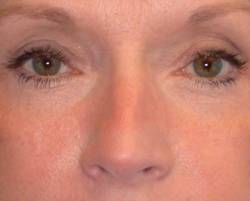 After Image: Patient # 24341 - 