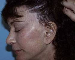Before Image: Patient # 70553 - 