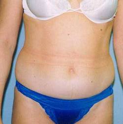 Before Image: Patient # 26228 - 