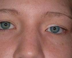 Before Image: Patient # 10992 - 