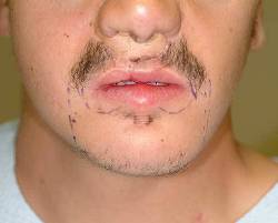 An image of a mans face that underwent a beard and mustache hair transplantation