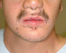 Before Image: Patient # 28317 - 