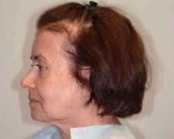 Before Image: Patient # 90484 - 