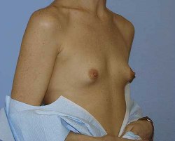 Before Image: Patient # 44398 - 