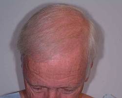 Before Image: Patient # 11305 - 