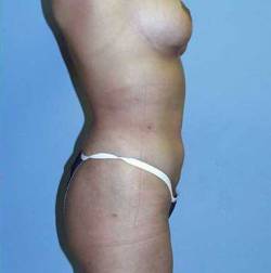 After Image: Patient # 47300 - 