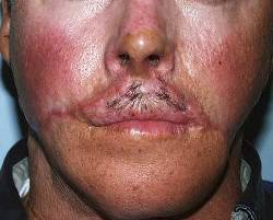 Before Image: Patient # 86139 - 