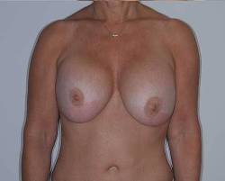 Before Image: Patient # 30415 - 