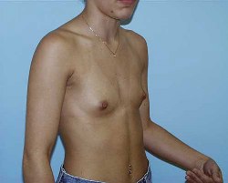 Before Image: Patient # 98111 - 