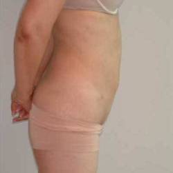 After Image: Patient # 79803 - 