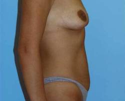 Before Image: Patient # 64975 - 