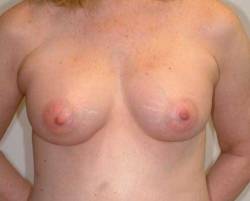 After Image: Patient # 79152 - 