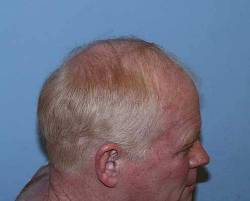 Before Image: Patient # 56242 - 