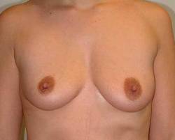 Before Image: Patient # 94467 - 
