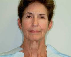 Before Image: Patient # 92609 - 