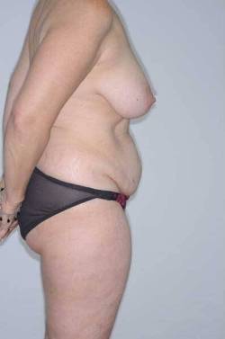 Before Image: Patient # 58011 - 