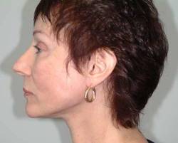 After Image: Patient # 29216 - 