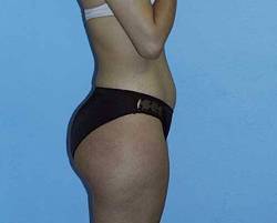 Before Image: Patient # 25322 - 