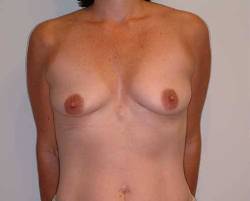 Before Image: Patient # 47329 - 
