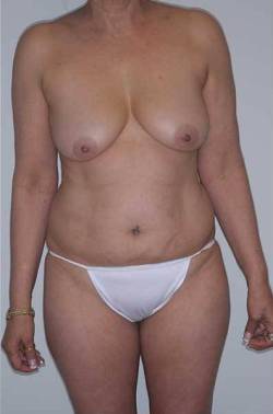 Before Image: Patient # 81426 - 