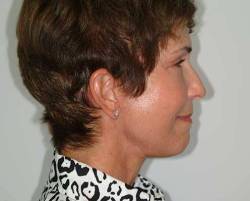 After Image: Patient # 92609 - 