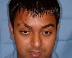Before Image: Patient # 54163 - 