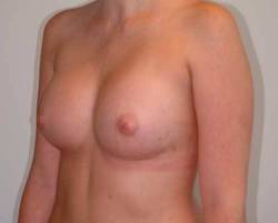 After Image: Patient # 66213 - 