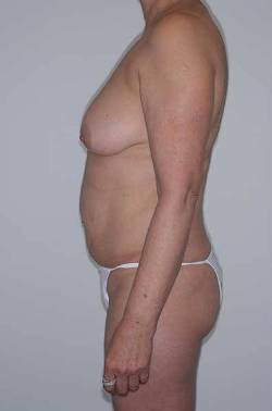 Before Image: Patient # 81426 - 