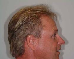 After Image: Patient # 10068 - 