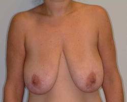 Before Image: Patient # 45985 - 