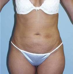 Before Image: Patient # 55841 - 