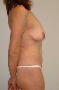Before Image: Patient # 69593 - 