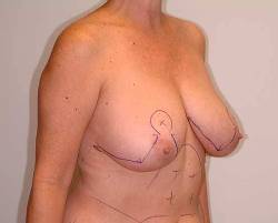 Before Image: Patient # 58331 - 