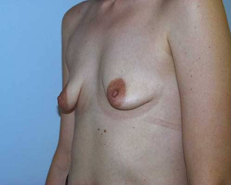 Before Image: Patient # 34852 - 