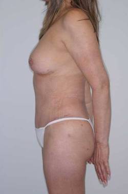 After Image: Patient # 81426 - 