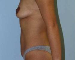 Before Image: Patient # 64975 - 