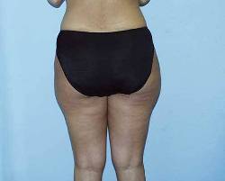 Before Image: Patient # 25322 - 