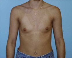 Before Image: Patient # 98111 - 