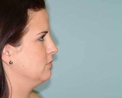 Before Image: Patient # 80256 - 