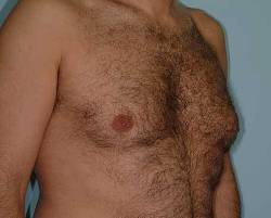 Before Image: Patient # 61222 - 