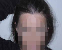 female patient with thicker, fuller hair after treatment by Dr. Alfonso Barrera