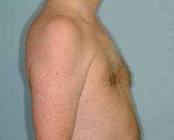 Before Image: Patient # 78514 - 