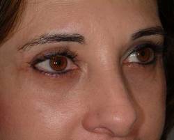After Image: Patient # 23251 - 