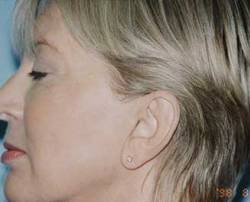 Before Image: Patient # 51186 - 
