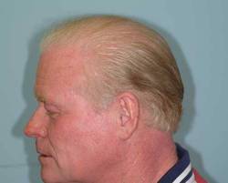 After Image: Patient # 56242 - 