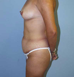Before Image: Patient # 64178 - 