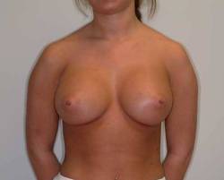 After Image: Patient # 62283 - 