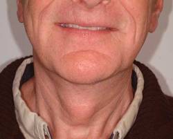 After Image: Patient # 11305 - 
