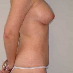 After Image: Patient # 28345 - 
