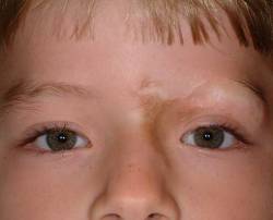 Before Image: Patient # 96913 - 